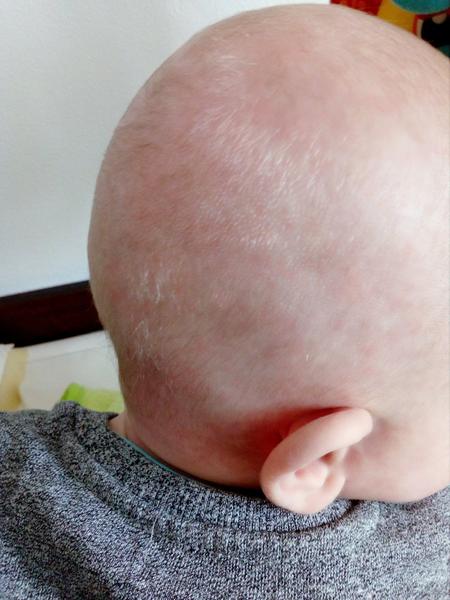 Červené flíčky kolem plíny