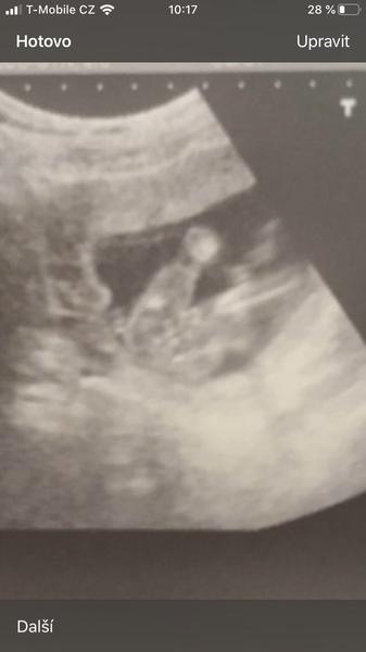 Chlapeček nebo holčička. Foto ultrazvuku. Co myslíte Vy?