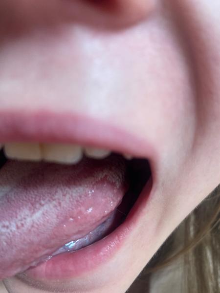 Je bezbolestný flek na jazyku běžný?