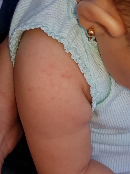 Foto - je to vyrážka nebo potničky?