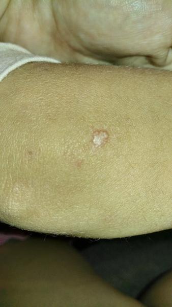 Útvar po štípnutí. Co by to mohlo být? Zajít k lékaři?