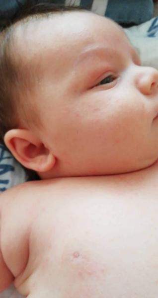 Alergie na mléčné výrobky. Jak vypadá stolice?