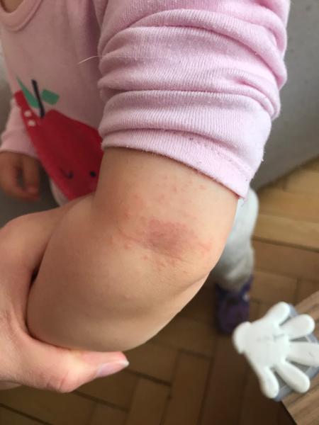 Vyrážka nebo ekzém. Co by to mohlo být? Volat naší dr.?