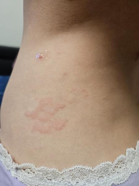 Vyrážka u dcery, neštovice. Jakou máte zkušenost?