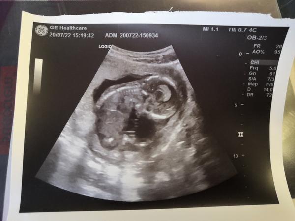 Lze zjistit velikost plodu z ultrazvuku?