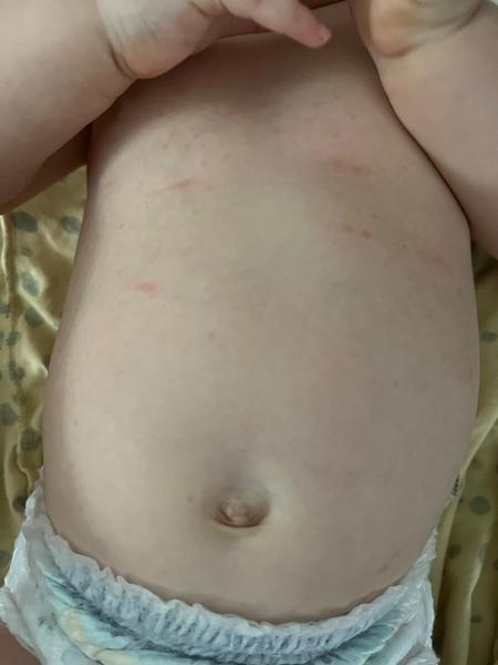 Možné příčiny vyrážky u kojence? Zkušenosti rodičů