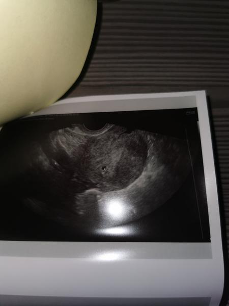 Začátek těhotenství. Máte s tímto zkušenost?