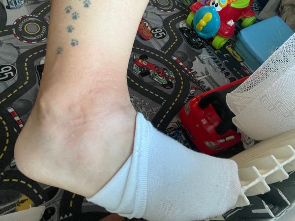 Co způsobuje svědění a vyrážku na kloubech?