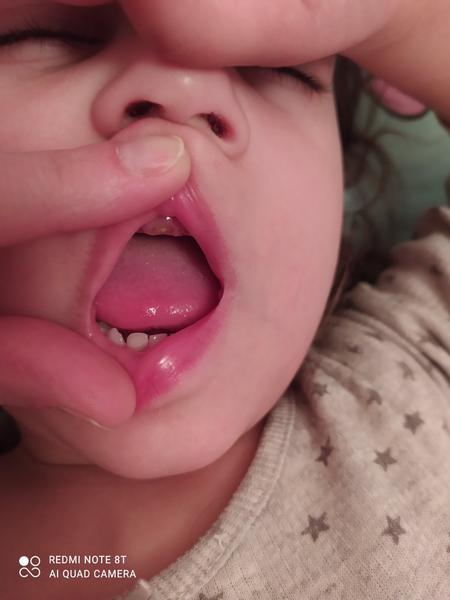 Zoufalá - zoubky 3leté holčičky. Co by s tím zubař udělal?