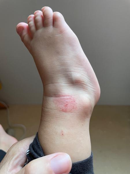 Je vyrážka na nožičce ekzém? Zkušenosti rodičů.