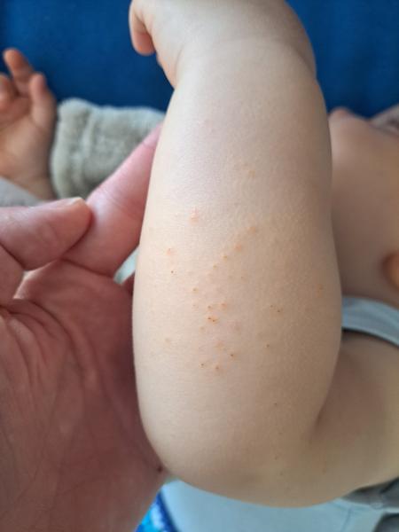 Červené pupínky na předloktí a lýtkách u miminka. Čím to může být?