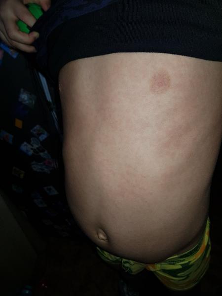 Je ta vyrážka spála nebo něco jiného?