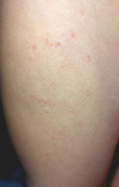 Vyrážka. Poradíte, prosím?