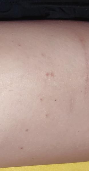 Zahadna vyrážka/ štipance