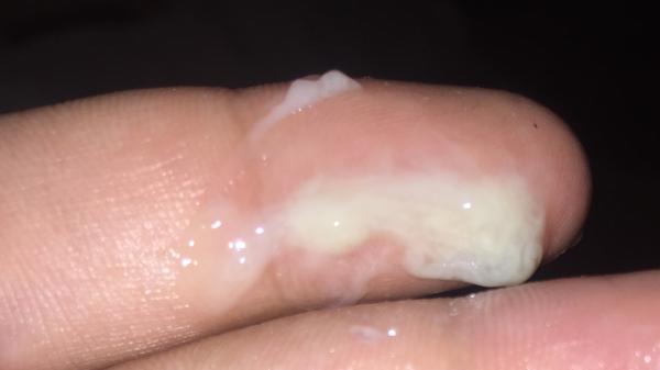 Je tohle hlenová zátka?