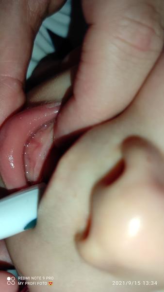 Co znamenají hnědé fleky na dětských zubech?