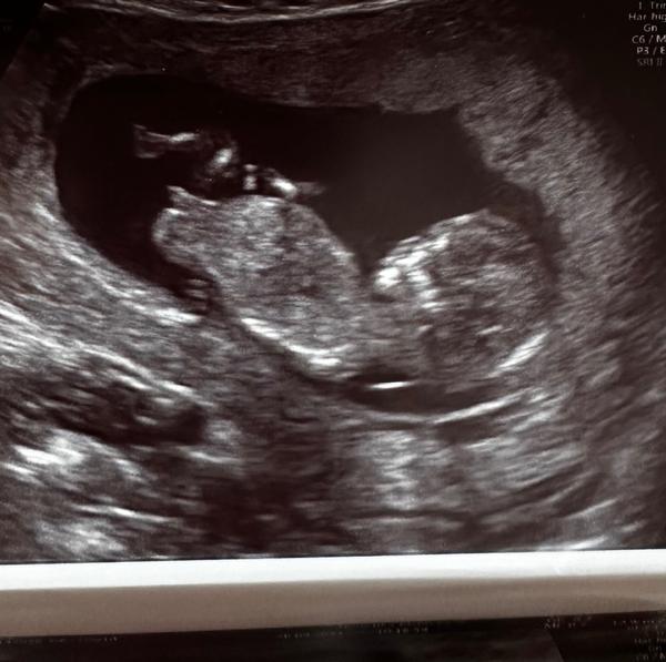 Odhad pohlaví dítěte ve 14. týdnu těhotenství?