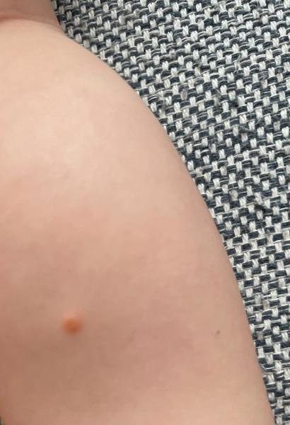 Co znamenají suché tečky po těle dítěte?