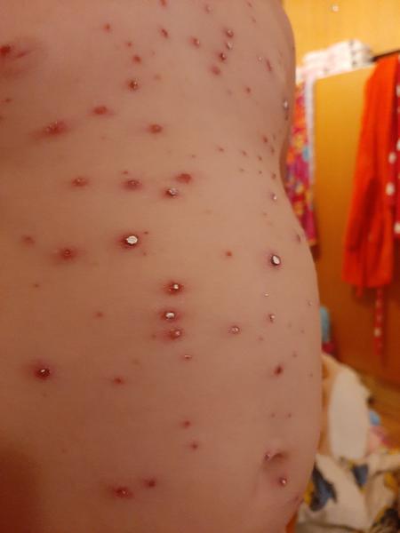 Mám mazat neštovice nebo nechat přirozeně hojit?