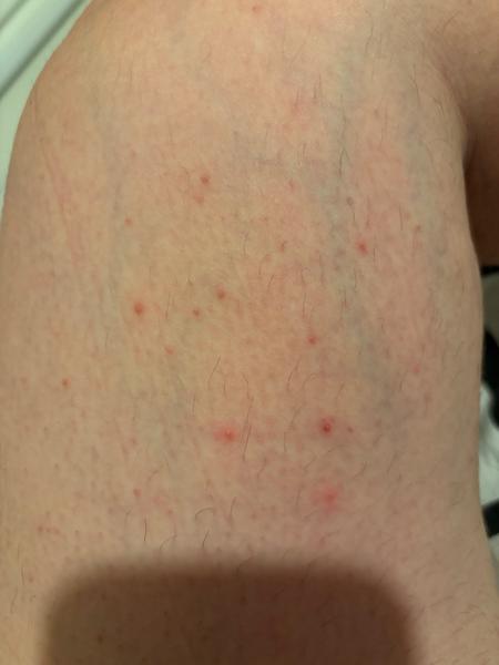 Může se jednat o svrab, nebo je to něco jiného?