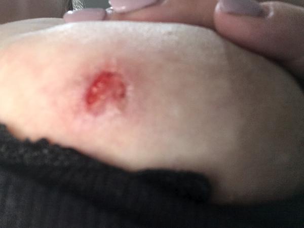 Otevřená ranka na prsu. Z čeho to může být?