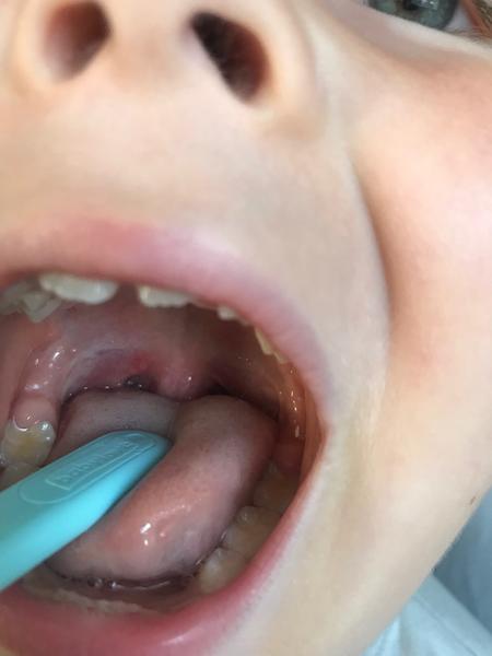 Může být drobný puchýřek příznakem angíny?