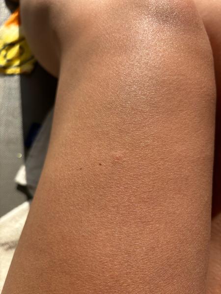 Co způsobuje svědivé vyrážky na těle? Zjistěte více!