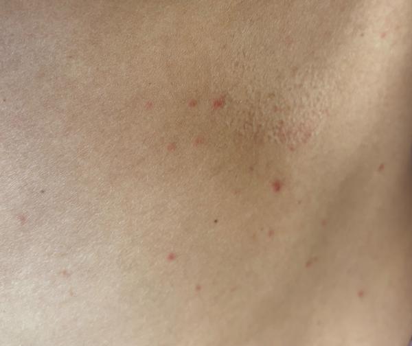 Červené fleky na těle. Co to může být?