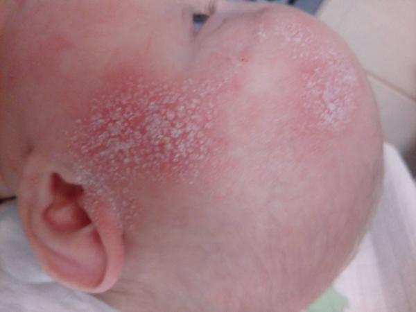 Ekzém u 4měsíčního miminka. Poradíte, prosím?