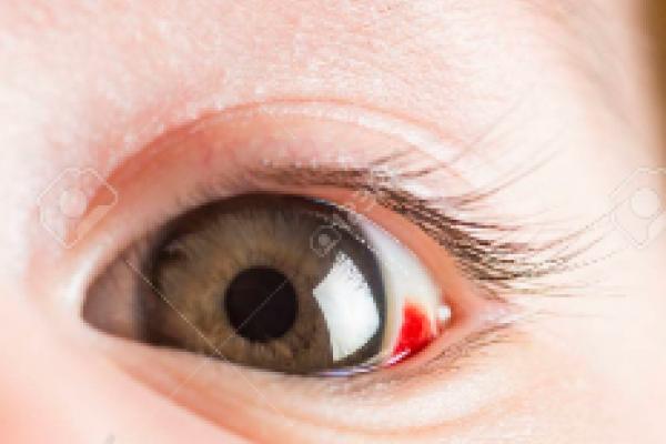Může krev v oku znamenat zánět spojivek?