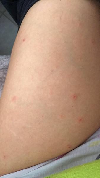 Exém / alergie / spálová angína. Nemá někdo podobnou zkušenost?