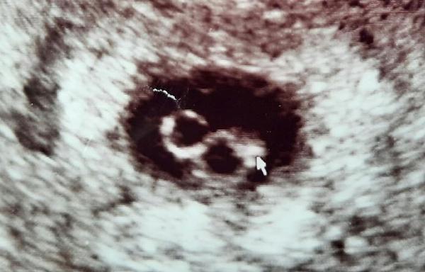 Pokračování k dotazu "Dvojčata v 8. týdnu - pouze jedno se srdeční akcí". Je vůbec reálná šance, že jedno přežije, když druhé odumře?