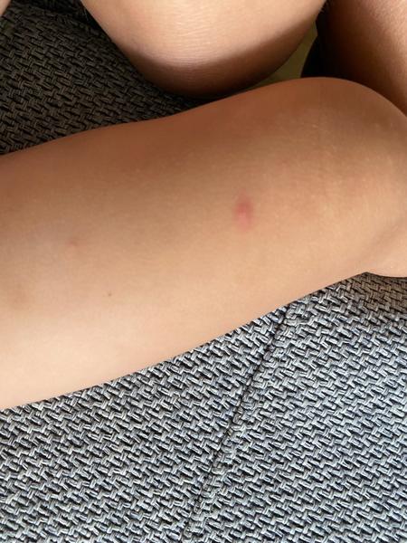 Jak léčit štípance od sametky či svilušky u dětí?