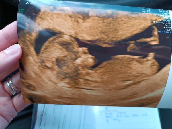 Bude to chlapeček podle hrbolku? Zkušenosti a tipy.