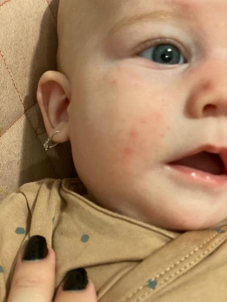 Je to alergie nebo ekzém?