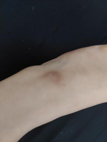 Zkušenosti s výskytem suchých fleků na tváři?