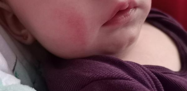 Jak řešit červené fleky na tváři u kojenců?