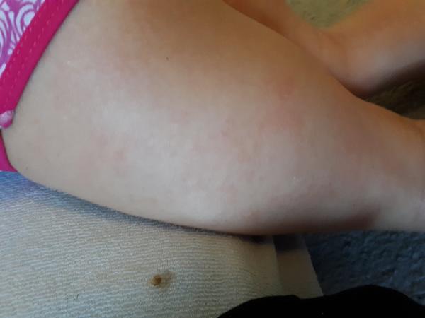 Je toto atopický ekzém?