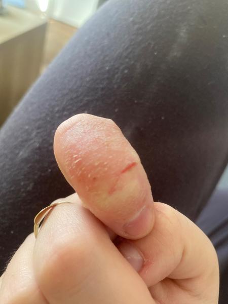 Může suchá kůže s puchýřky znamenat vyrážku?