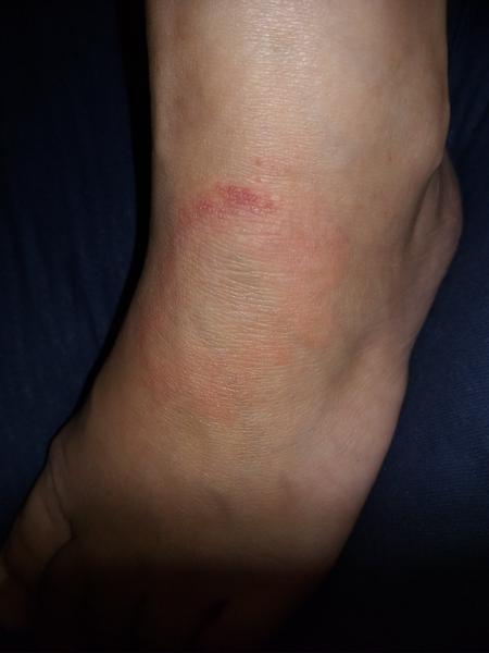 Červený flek na nártu. Borelióza, mykóza nebo něco jiného?