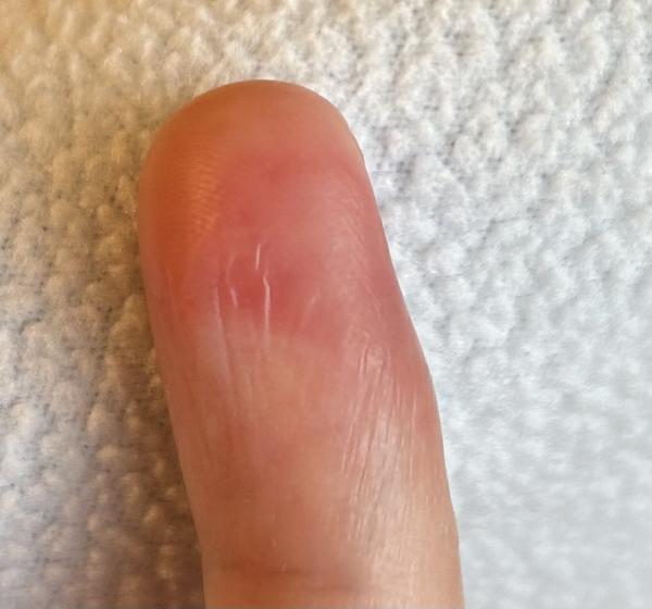 Vodnaté pupínky a zarudlý flek na prstu: Příčiny?