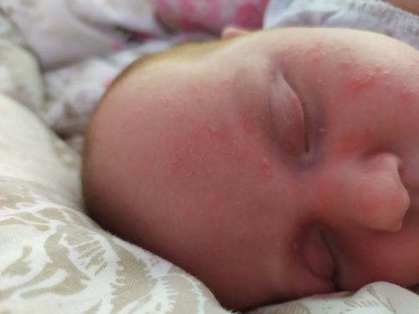 Vyrážka, alergie.... Co to je?