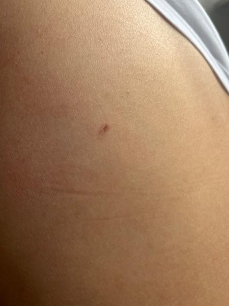 Mám se bát melanomu u drobného škrábance na zádech?
