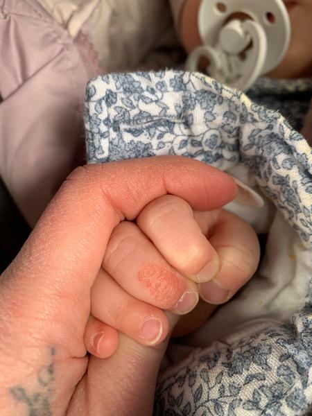 Jak řešit suchá místa a ekzém u miminka?