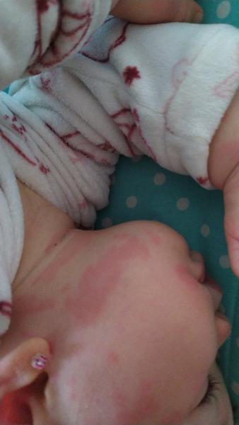 Zkušenosti s vyrážkou u miminka. Co pomáhá?