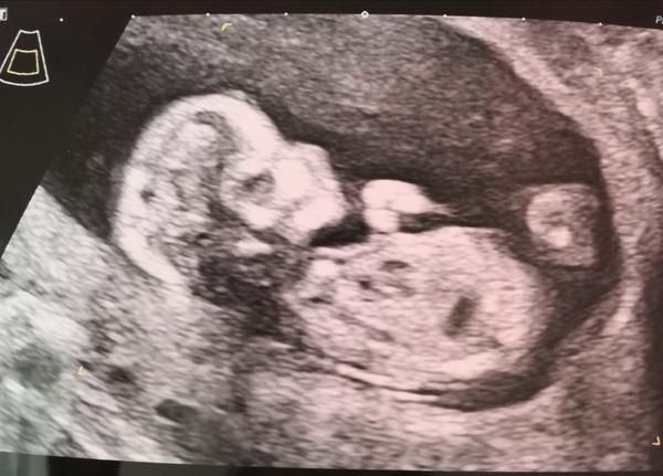 Poznáte pohlaví miminka? Mimčo se nám schovává