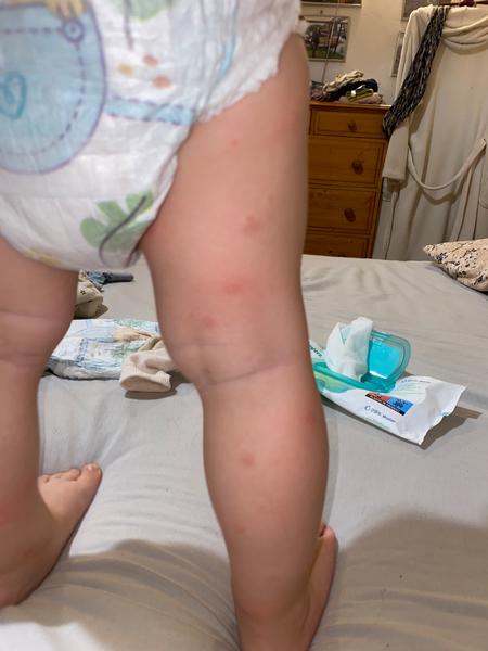 Vyrážka u dítěte: Jakou nemoc může způsobovat?