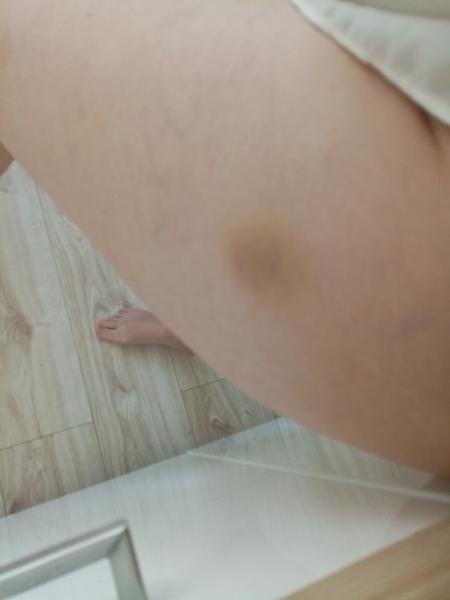 Modřiny na dolních končetinách - z čeho můžou být?