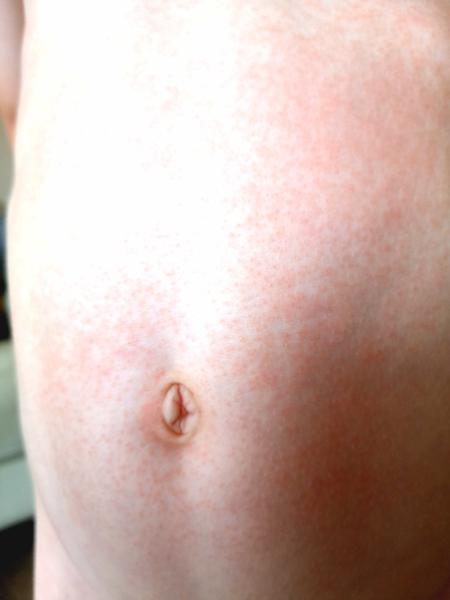 Vyrážka bez teplot. Mohlo by se jednat o potravinovou alergii?