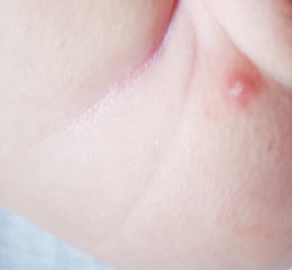 Jeden velký pupínek na zadečku kojence. Co to může být?